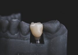 Fairhope Same-Day Dental Crowns (CEREC)