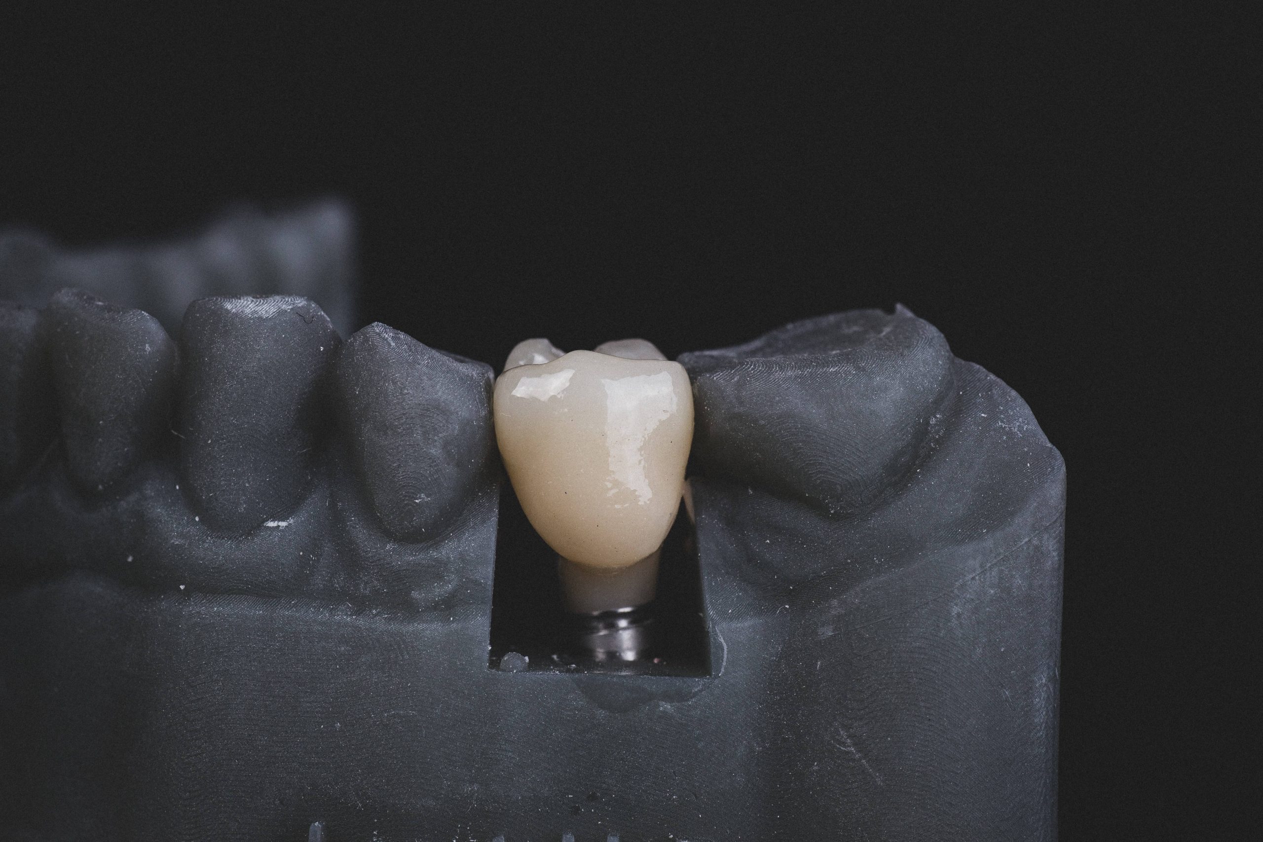 Fairhope Same-Day Dental Crowns (CEREC)